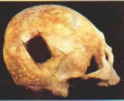 chirurgia_etadelbronzo